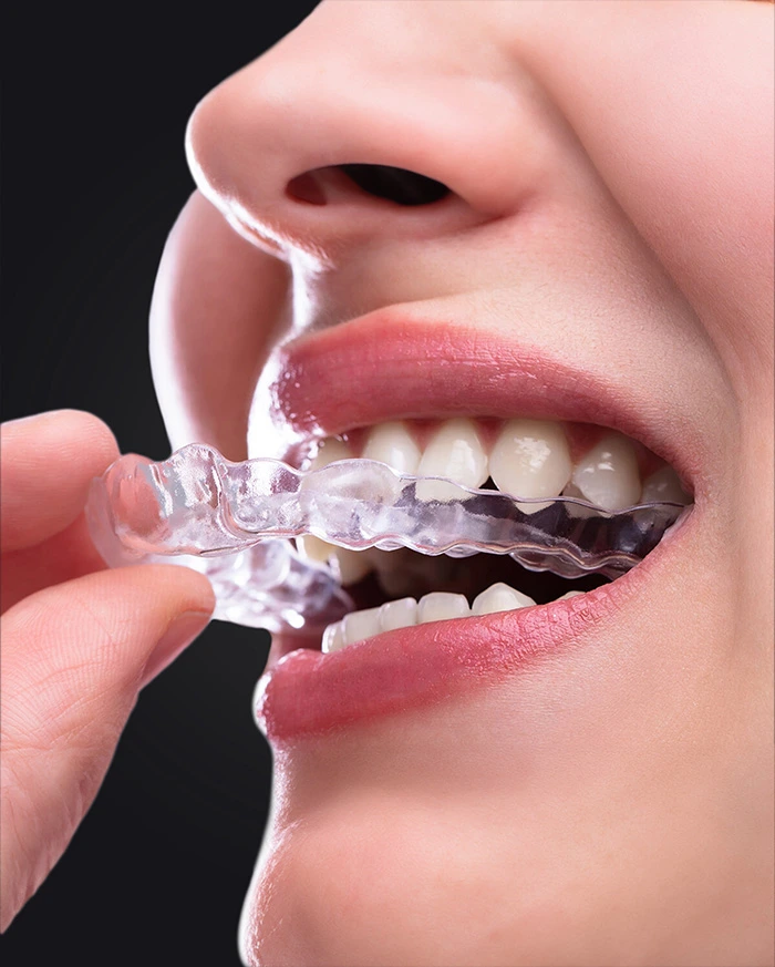 Comfortable dental aligners - pain free orthodontic treatment