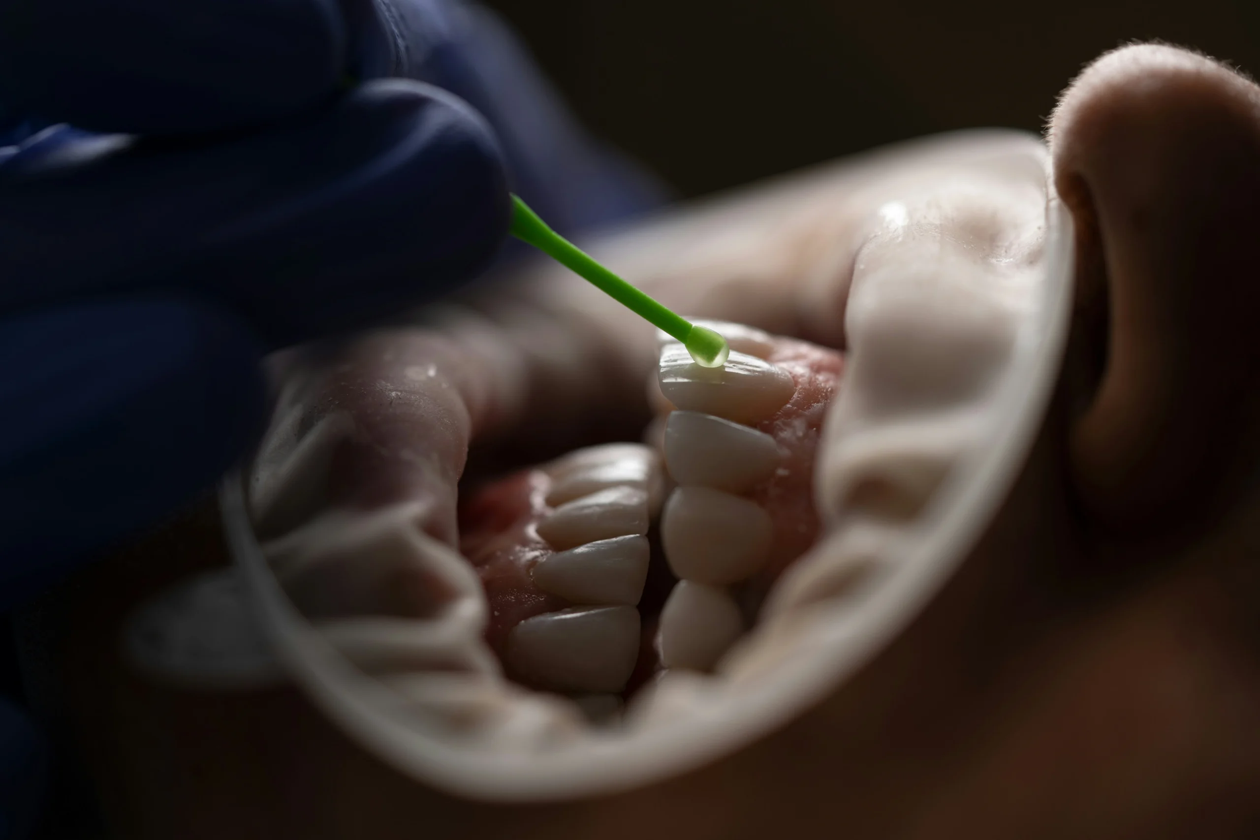 Dentist treating patient at Golden Crown