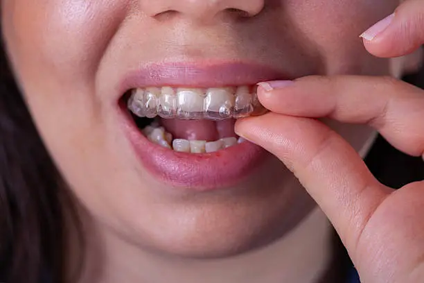 Patient wearing clear aligners at Golden Crown Dental Surgery