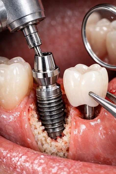 Root canal treatment at Golden Crown Dental Surgery Lahore