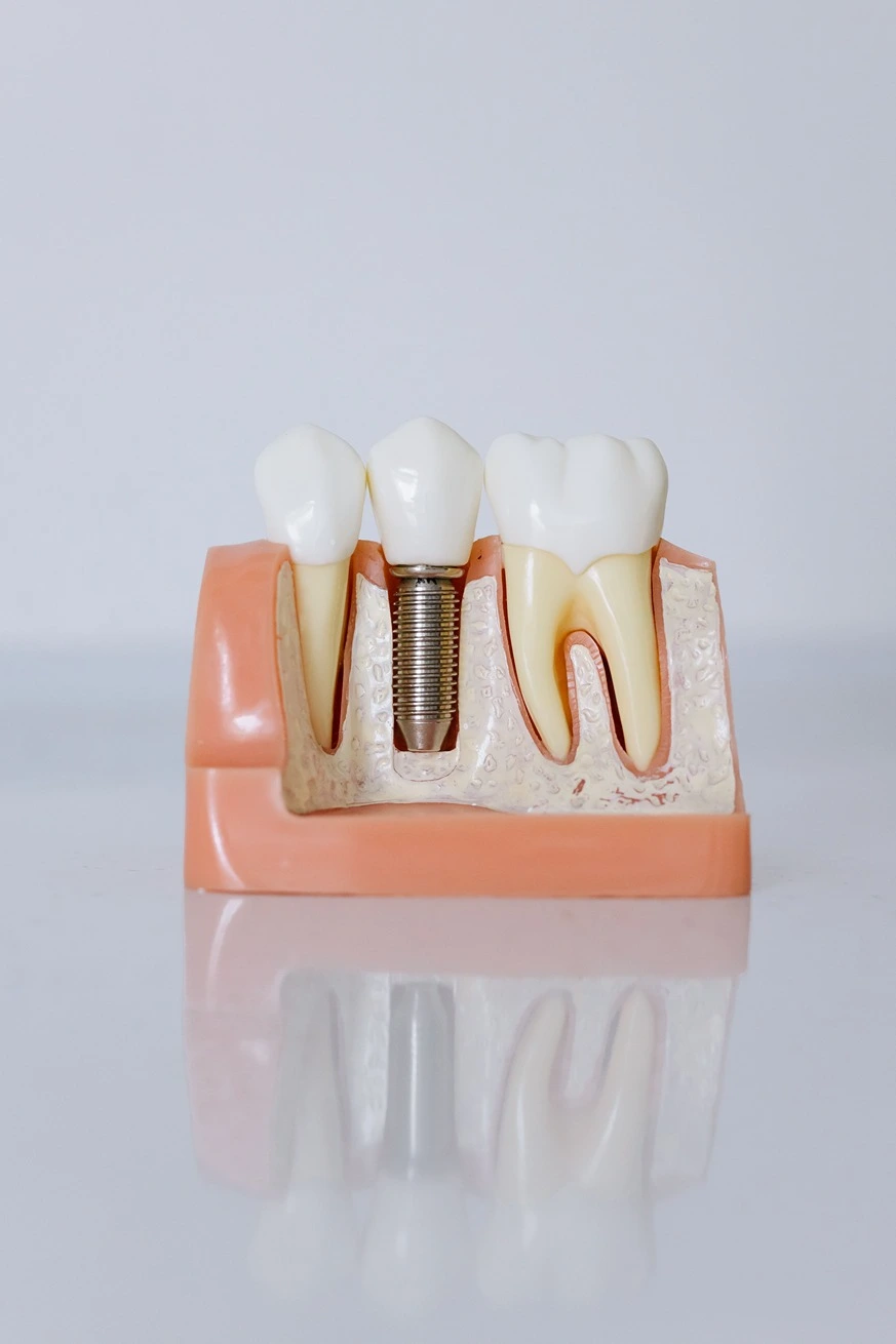 Bone preservation with dental implants