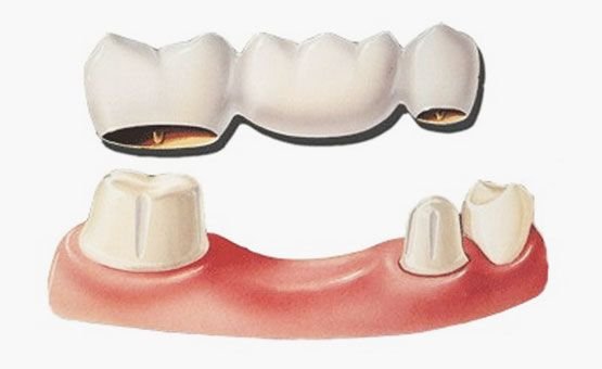 Dental bridge model at Golden Crown Dental Surgery