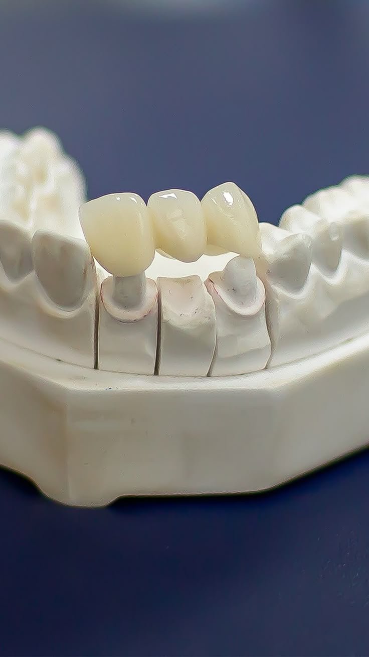 Dental bridge treatment at Golden Crown