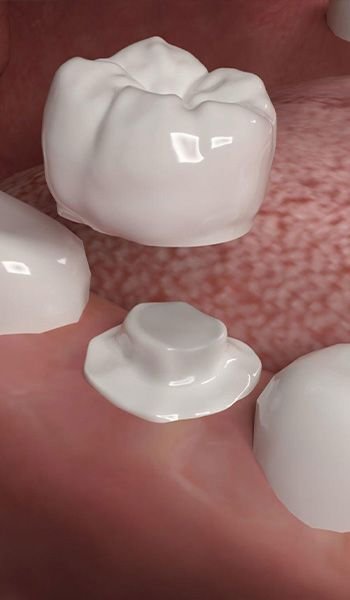 Dental crown treatment at Golden Crown