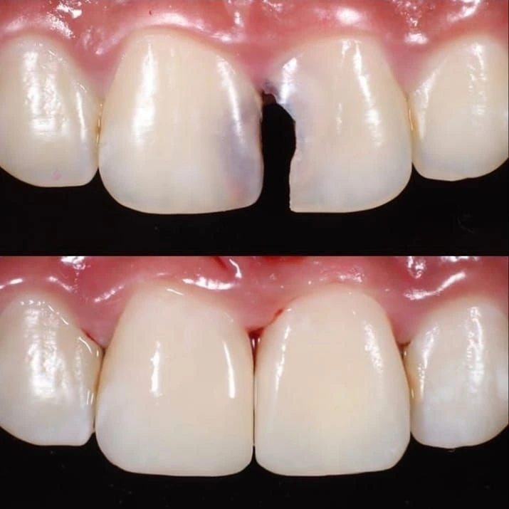 Before and after dental restoration at Golden Crown Dental Surgery Lahore