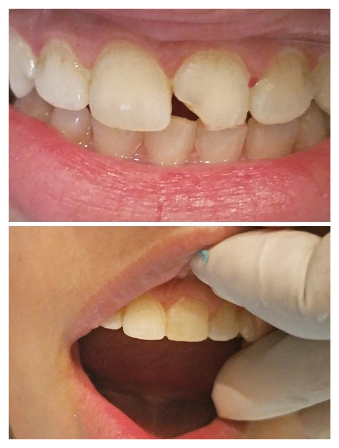 Porcelain veneers for damaged front teeth Lahore