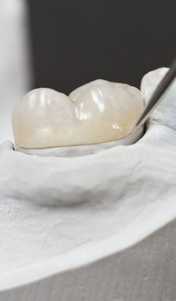Inlays and onlays treatment at Golden Crown