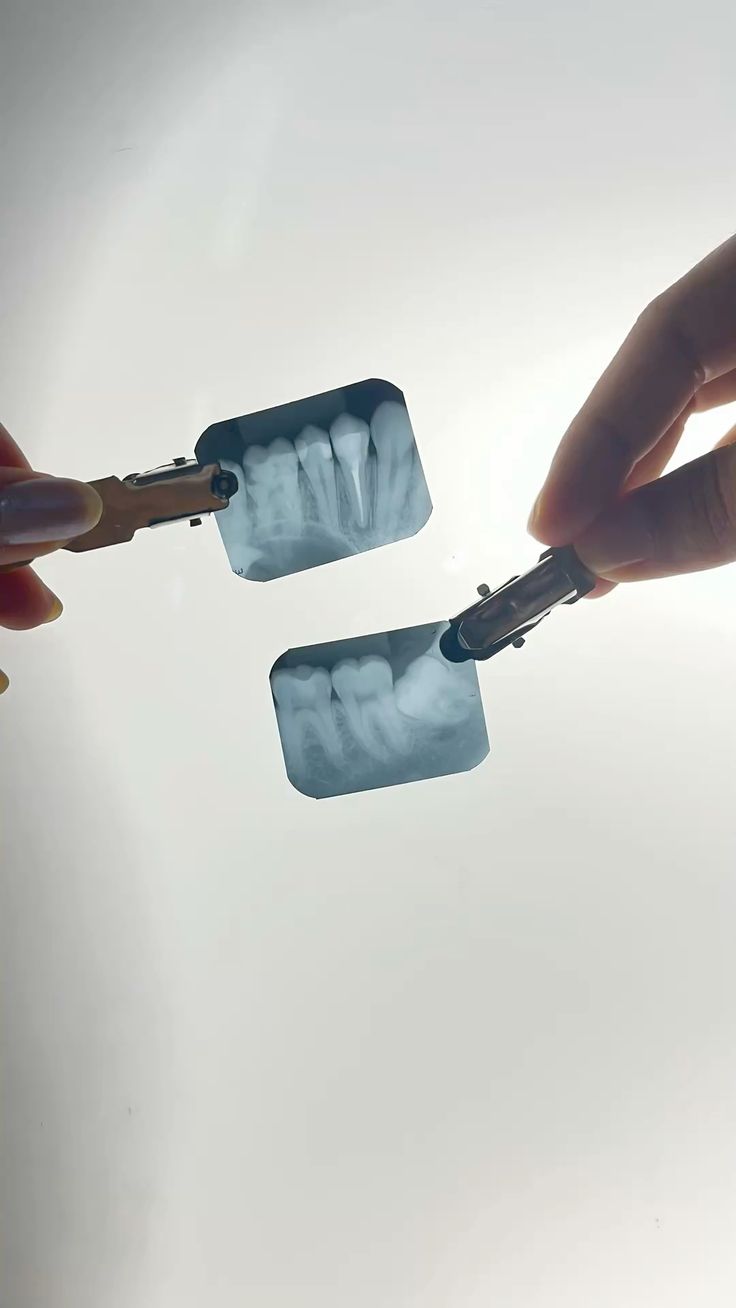 Jaw fracture treatment Lahore Pakistan Golden Crown Dental Surgery