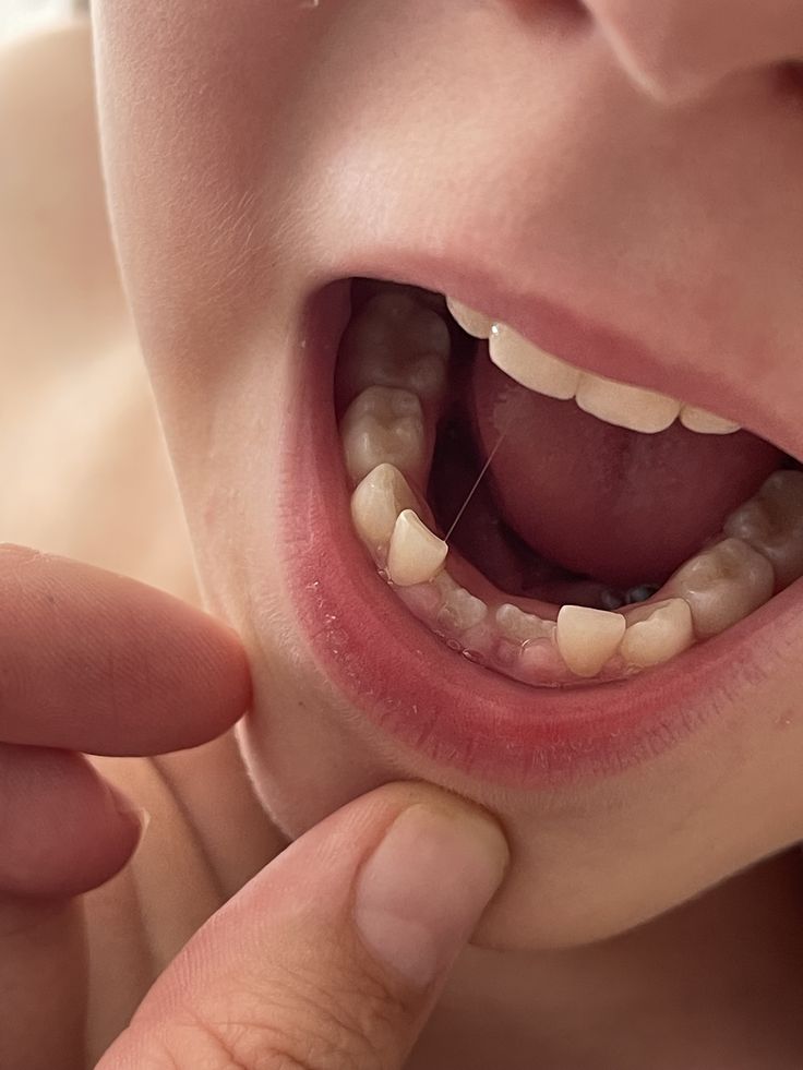 Healthy gums reattachment root planing