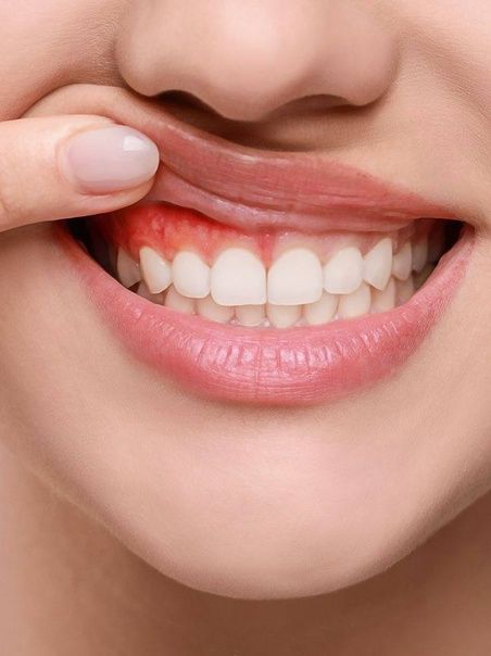 Prevention of gum disease with teeth scaling