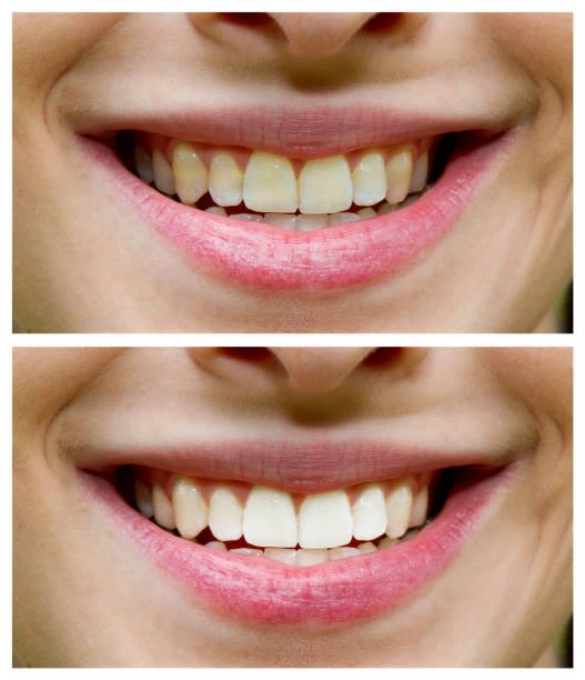 Quick results from teeth whitening treatment