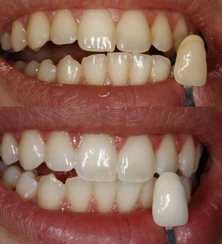 Dental bonding for chipped teeth in Lahore