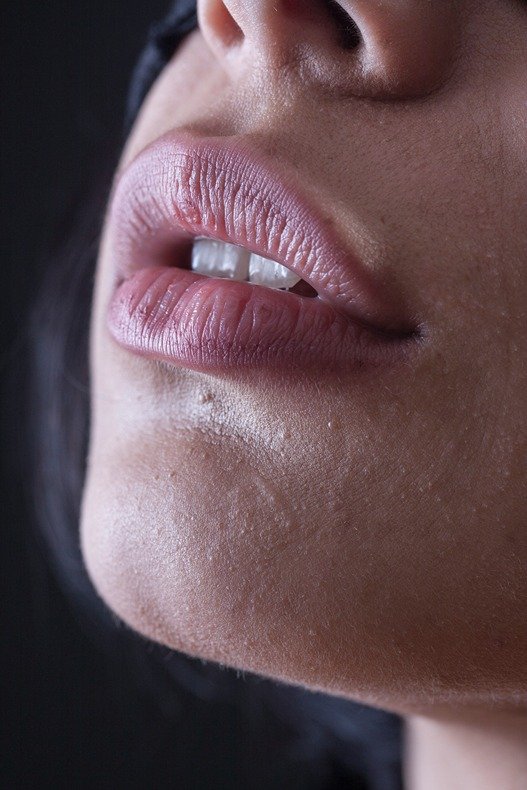 Lip filler injection procedure at Golden Crown Dental Surgery