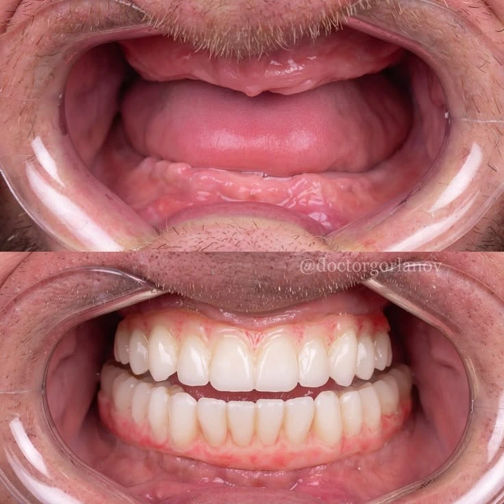 Full mouth reconstruction and rehabilitation Lahore